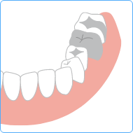奥歯の詰め物✕2と銀歯の場合
