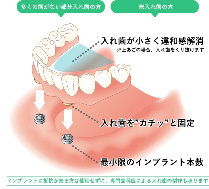 入れ歯＋インプラント治療の装着の様子