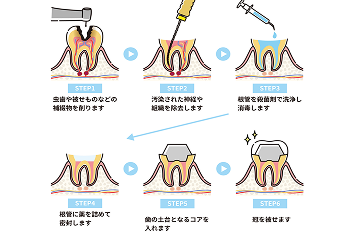 根管治療は通常1〜3日で完了