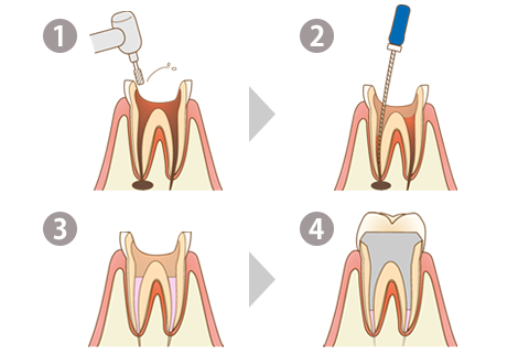 根管治療は通常1〜3日で完了