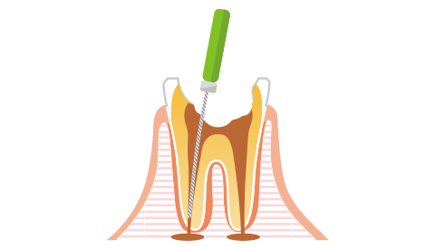 根管内のお掃除・殺菌