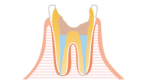根管充填と歯の土台作り